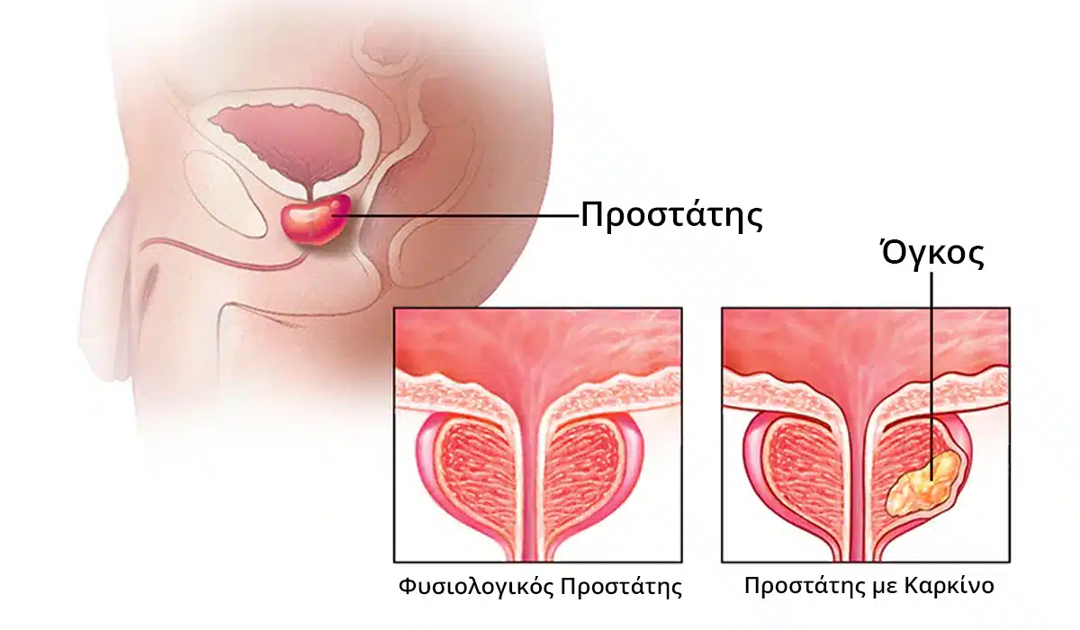 prostatis-me-karkino-ogko.jpg